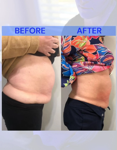 Side-by-side belly shots. Before: belly rolls. After: flatter belly.