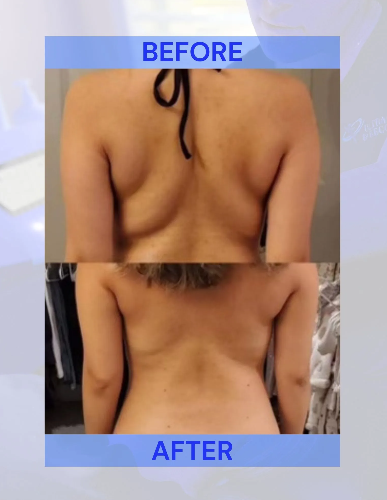 Before and after photos of a person's back, showing reduction in back fat.