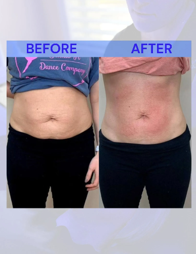 Before-and-after of a person's torso. Left side: stomach with visible fat, wearing a shirt. Right side: same stomach, flatter, red skin.