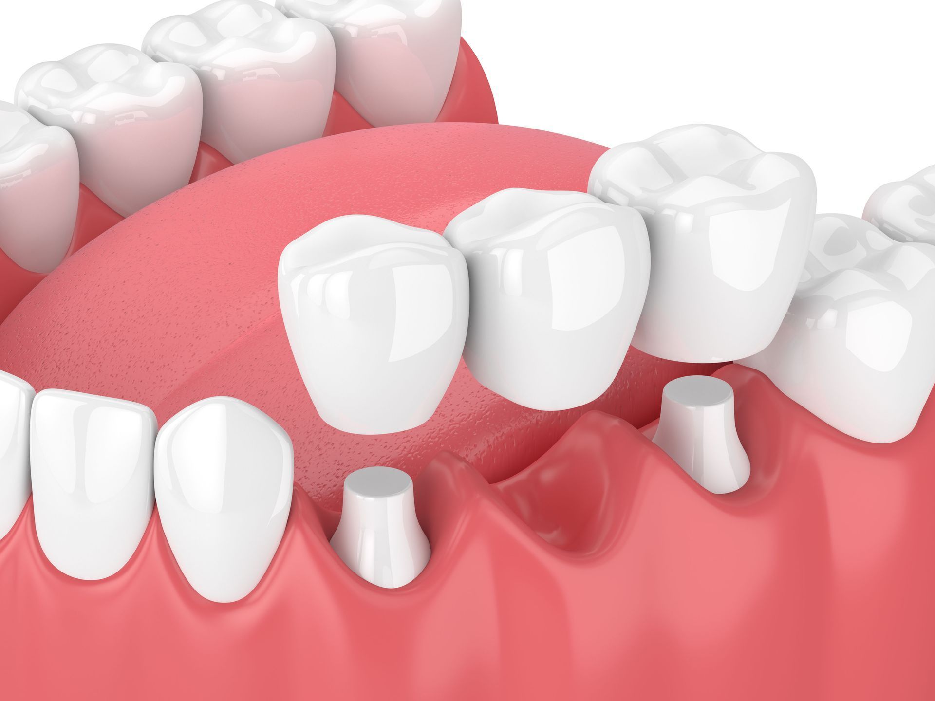 Close-up illustration of a pink gum line with several missing teeth and dental implants.