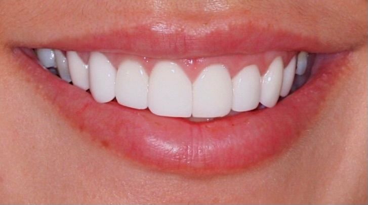 An image of teeth after a dental service