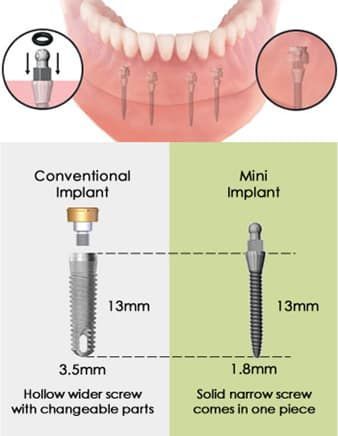 A diagram of a conventional implant and a mini implant