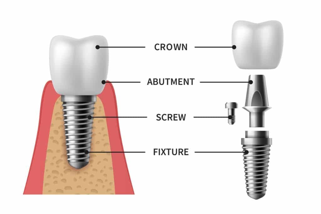 A diagram showing the parts of a dental implant.