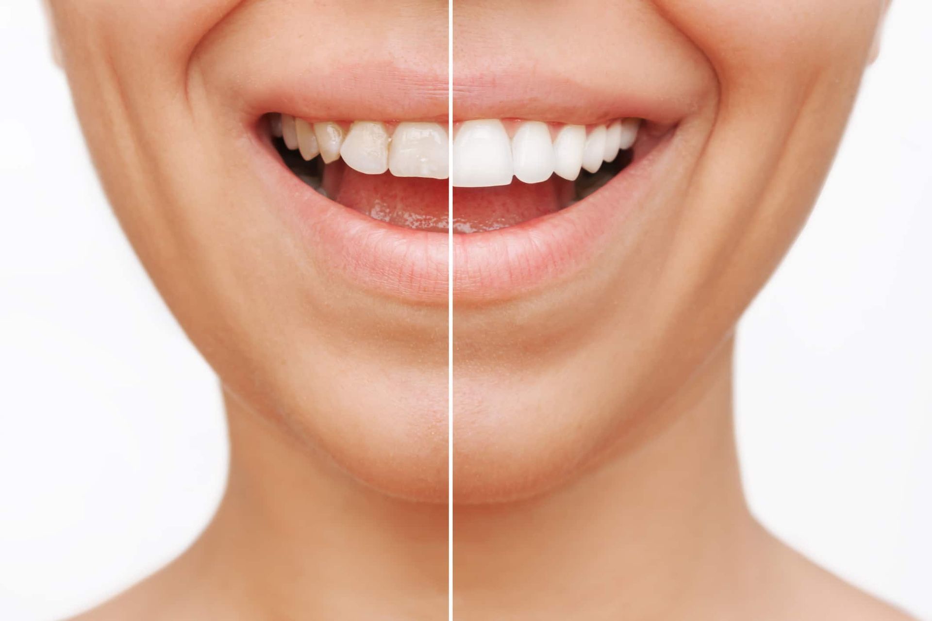 A before and after picture of a woman 's teeth.