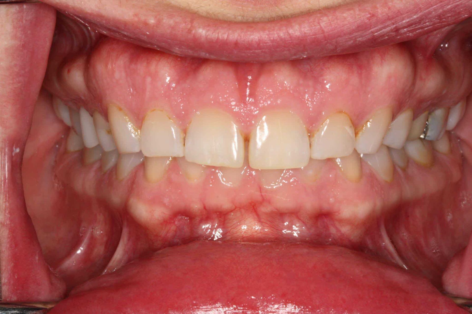 A close up of a person 's teeth and mouth.