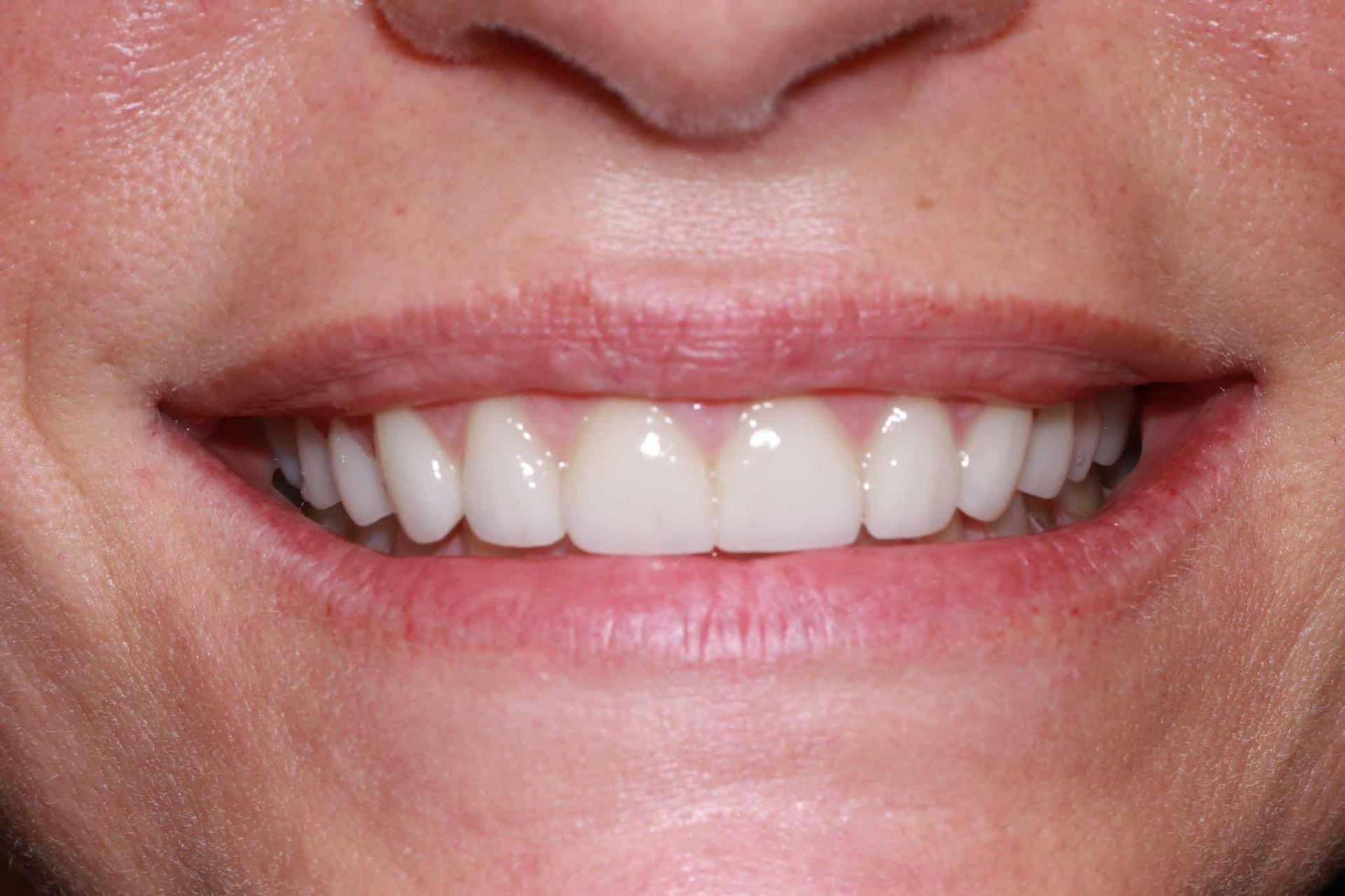 A close up of a woman 's smile with white teeth.