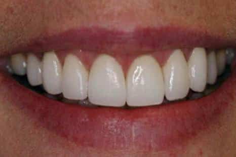 A close up of a woman 's smile with white teeth.