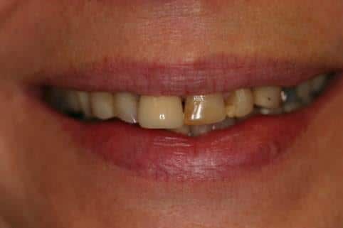 A close up of a woman 's mouth with a broken tooth.