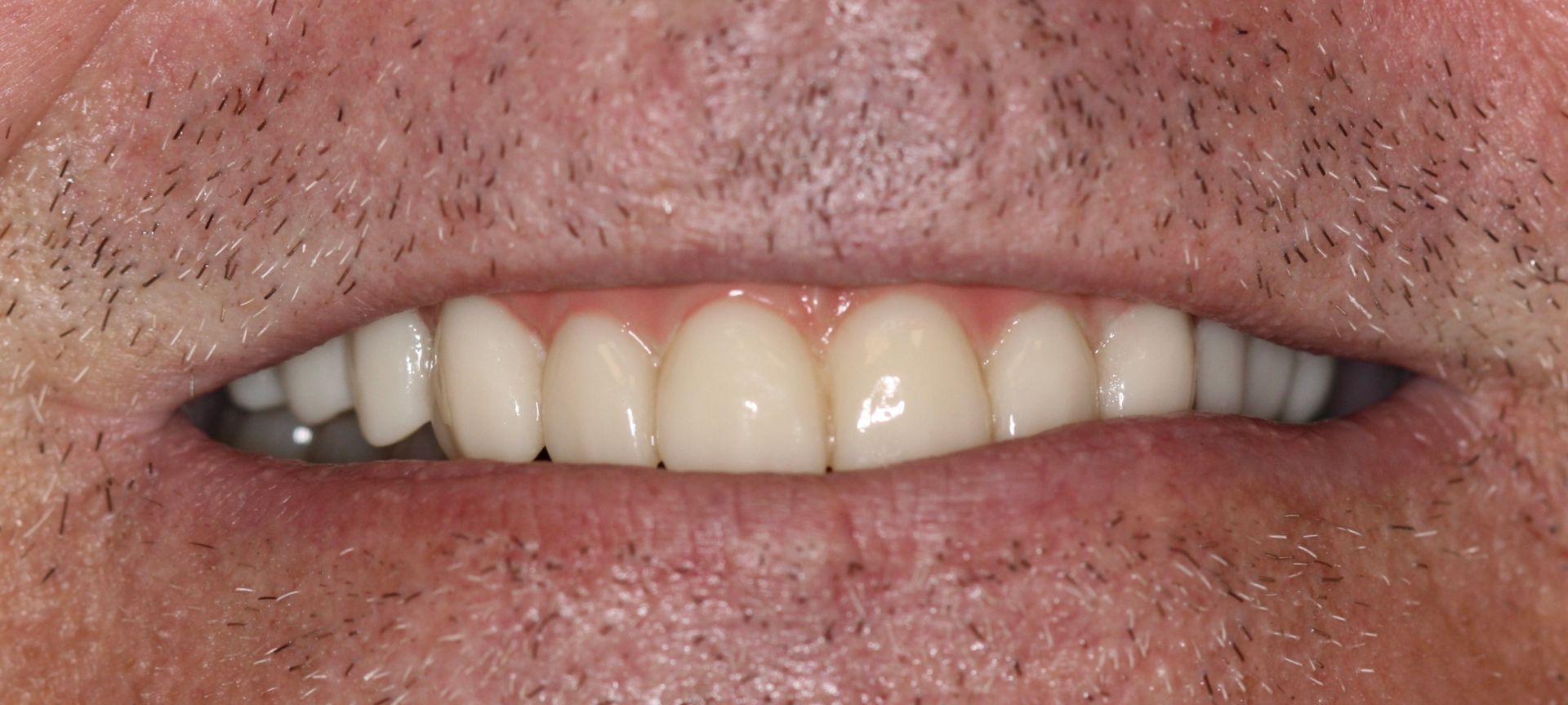 An image of teeth after a dental service