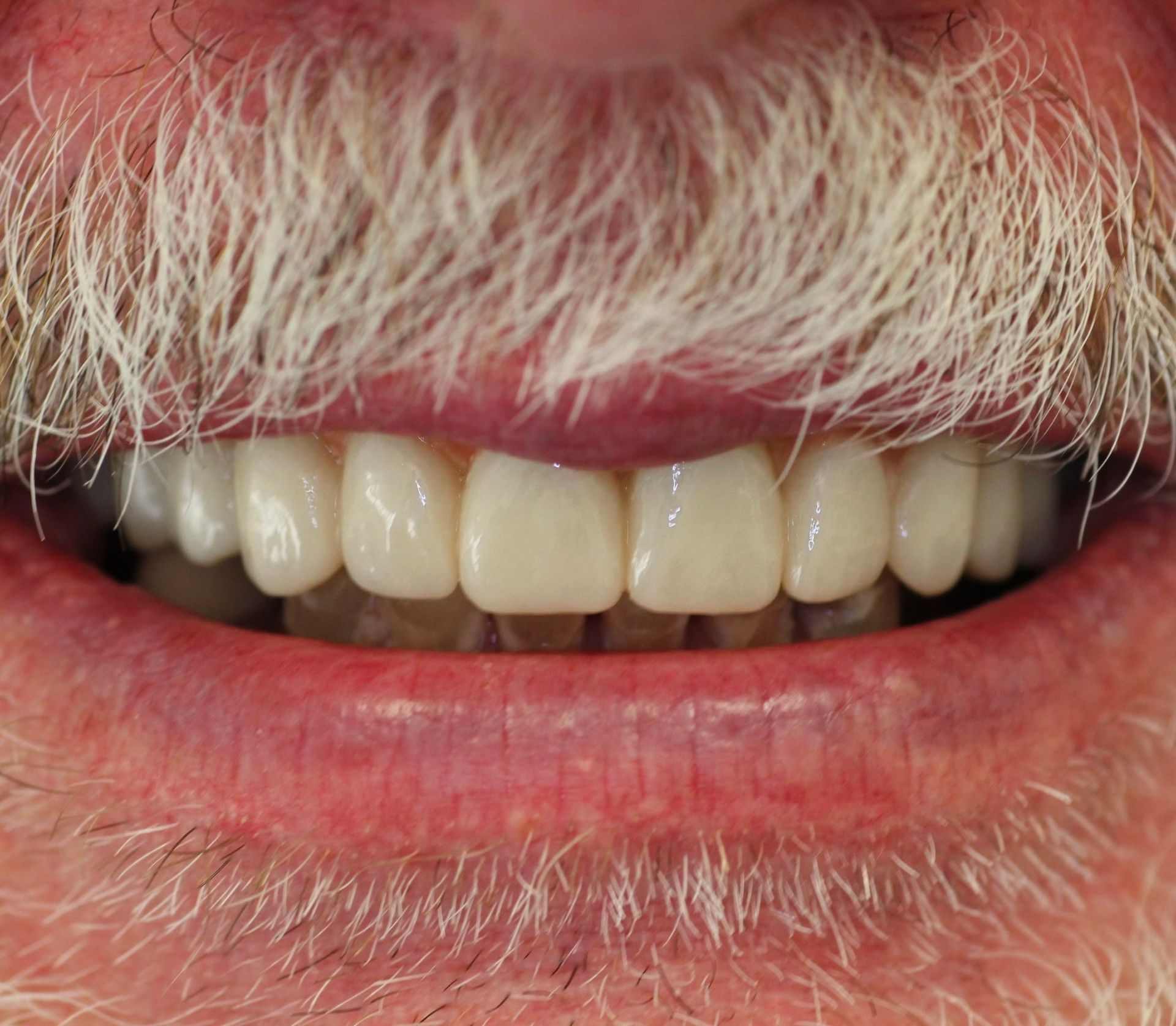 An image of teeth after a dental service