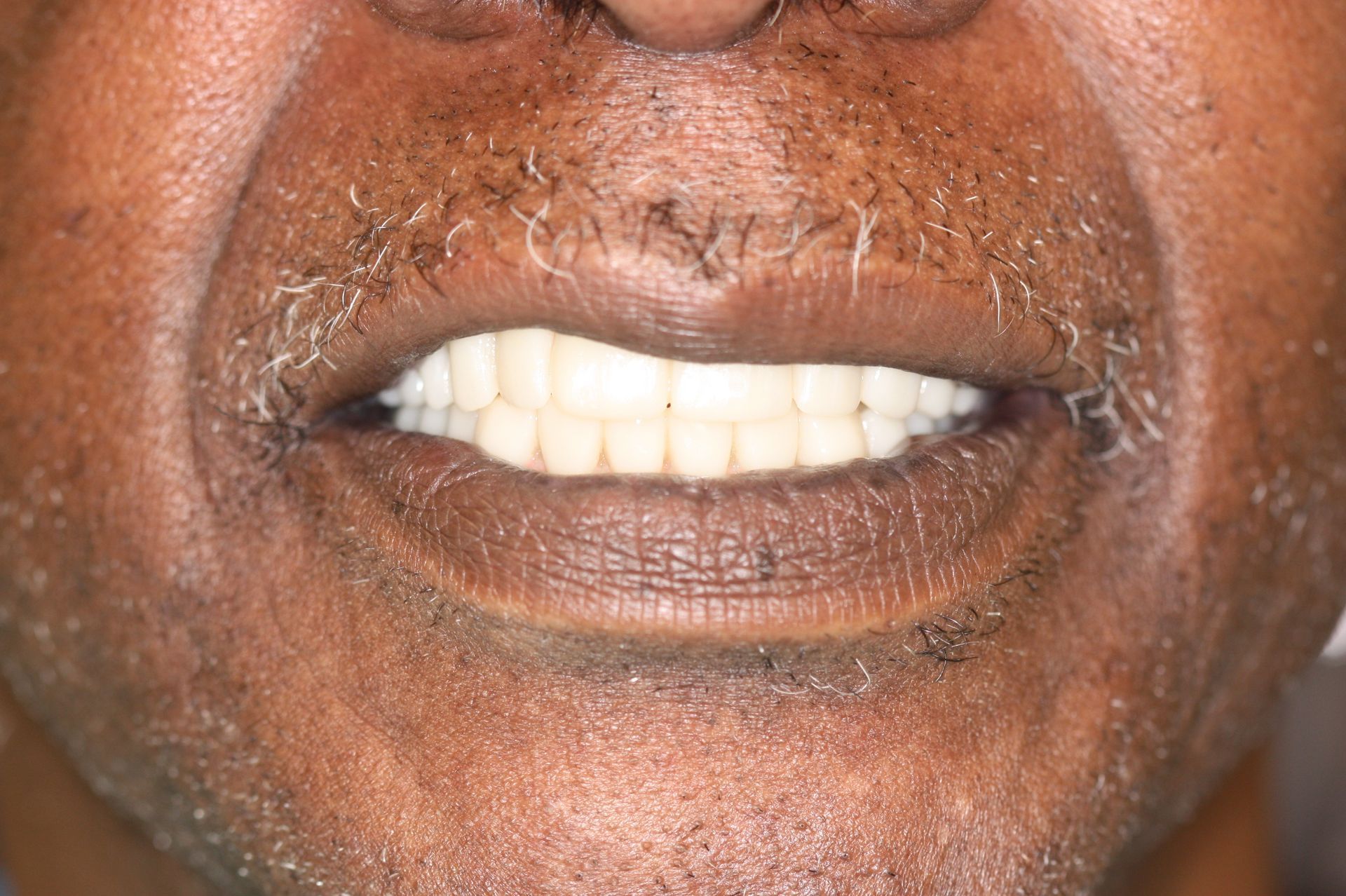 An image of teeth after a dental service