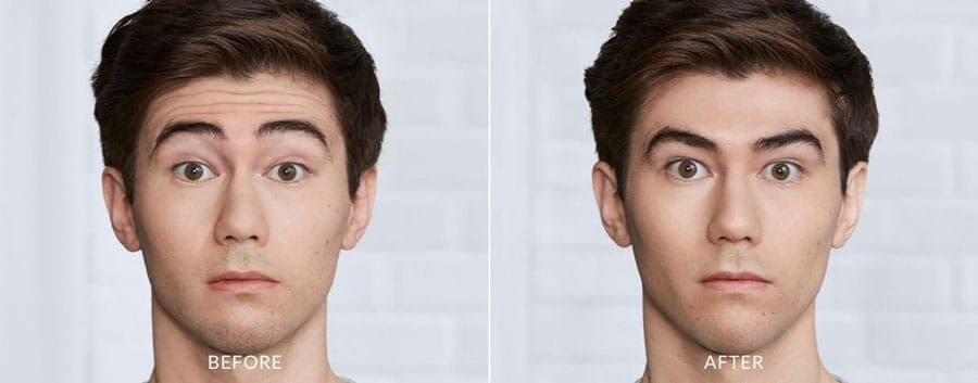 A before and after photo of a man 's forehead.