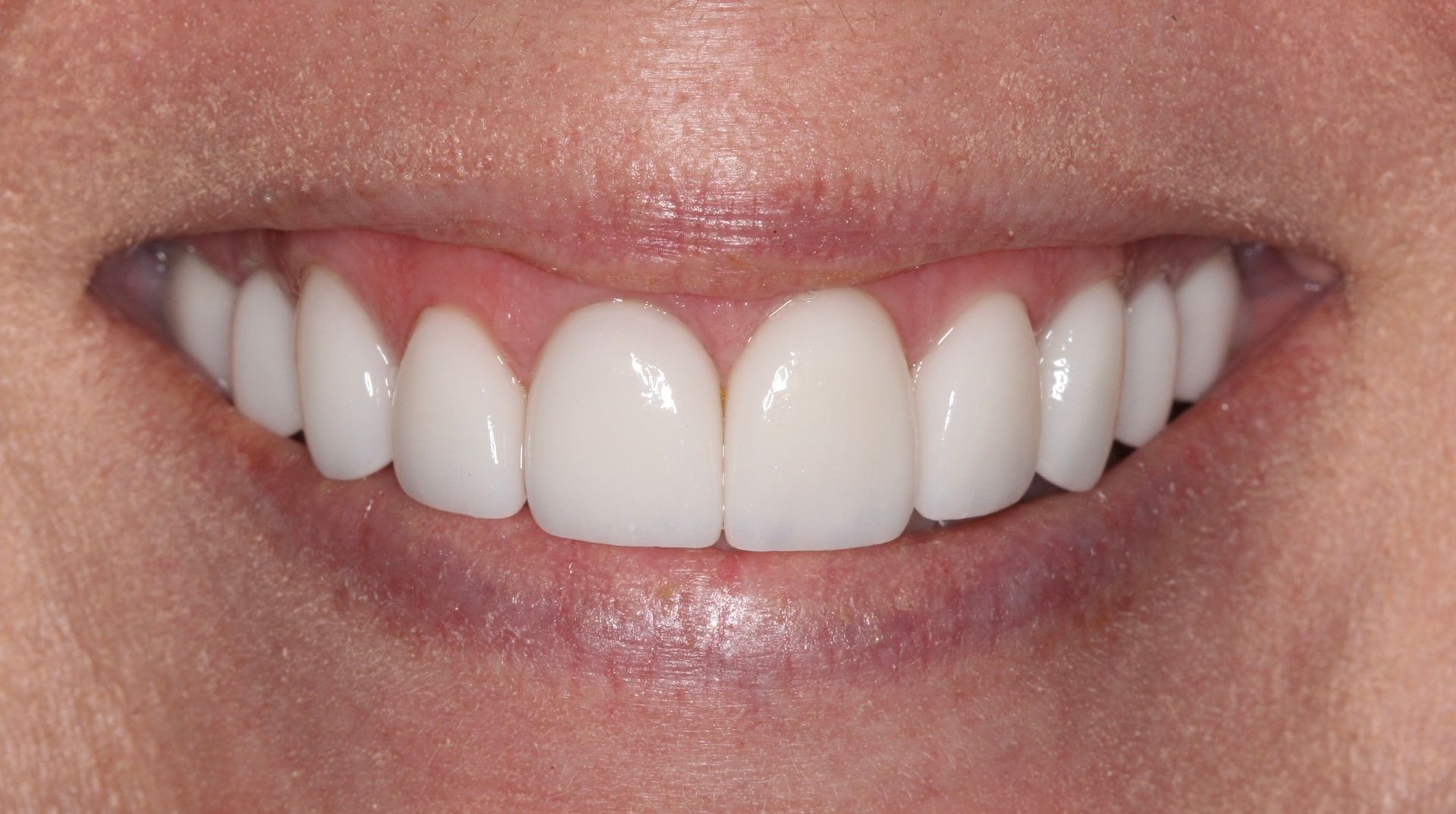 An image of teeth after a dental service