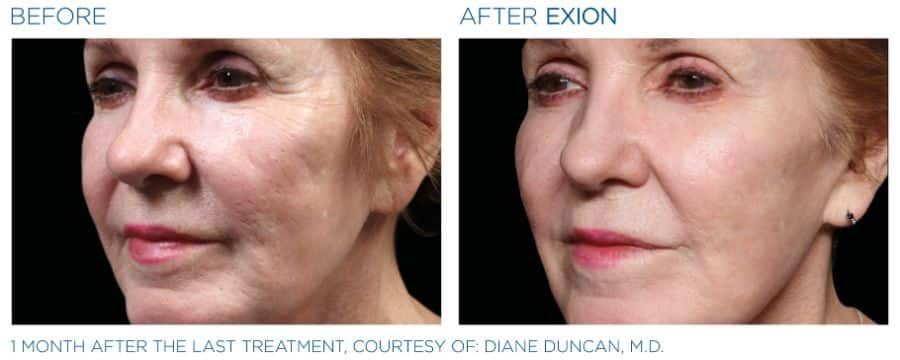 A before and after photo of a woman 's face.