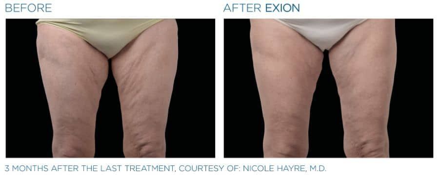Before and after exion treatment