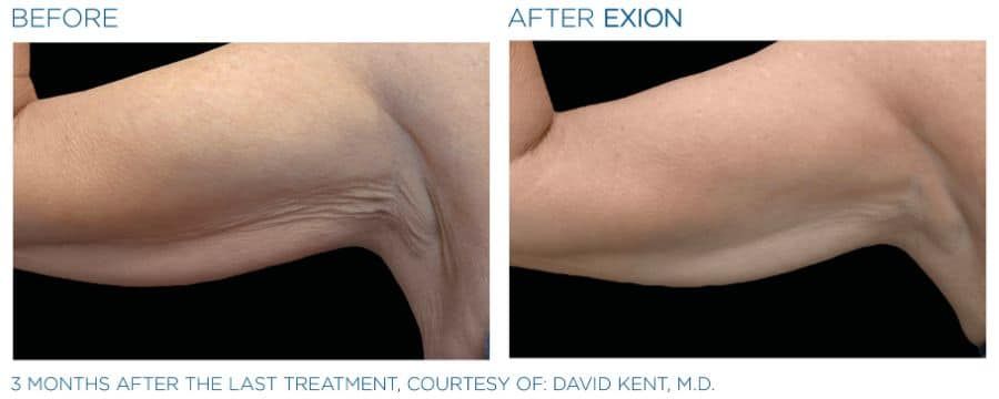 A before and after photo of a woman 's arm.