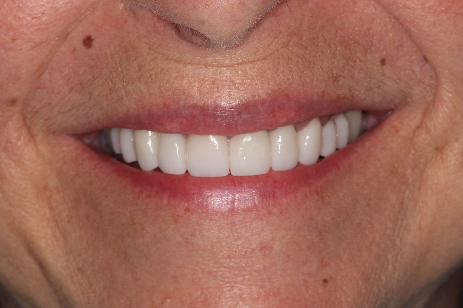 An image of teeth after a dental service