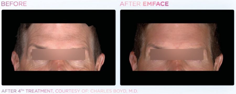 A before and after picture of a man 's forehead.