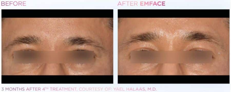 A before and after photo of a woman 's forehead.