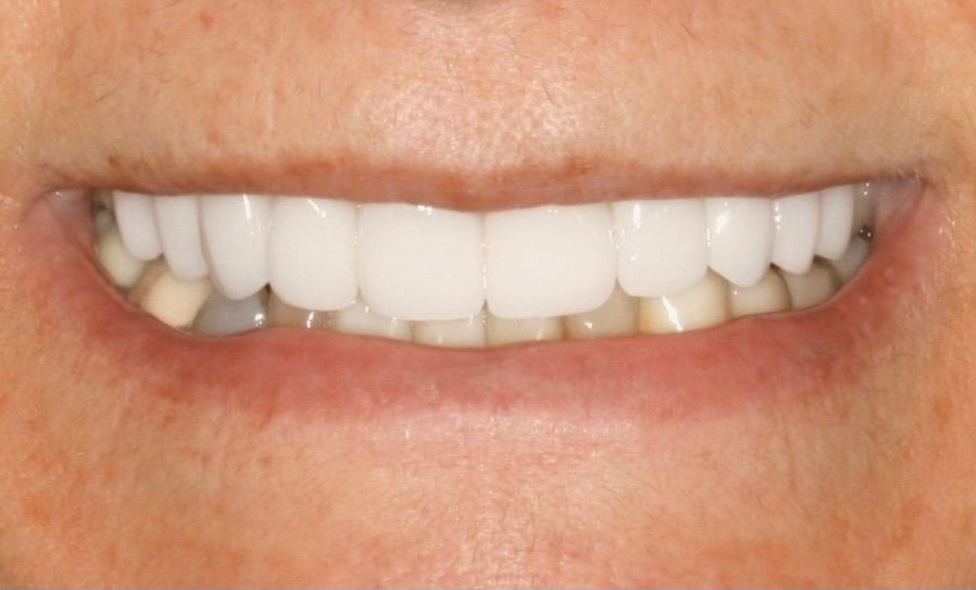 An image of teeth after a dental service