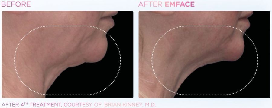 A before and after image of a woman 's neck