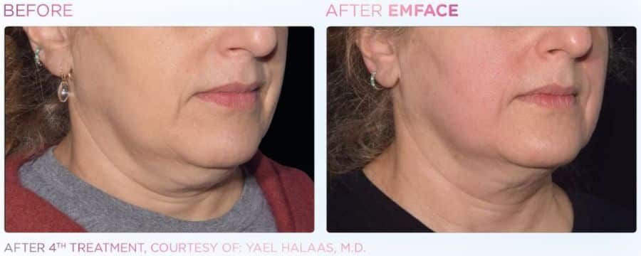A before and after photo of a woman 's neck and face.