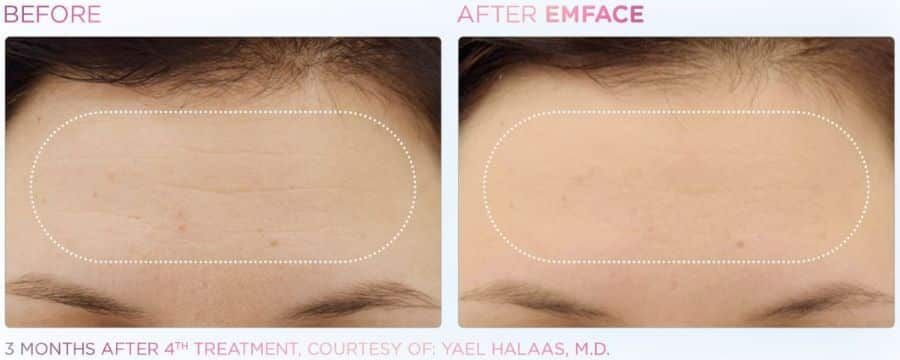 A before and after photo of a woman 's forehead