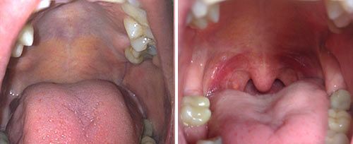 A before and after picture of a person 's mouth and throat.