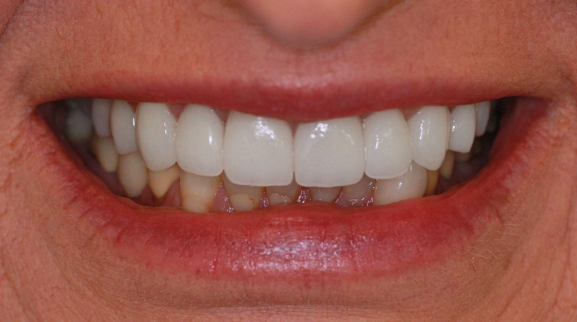 An image of teeth after a dental service