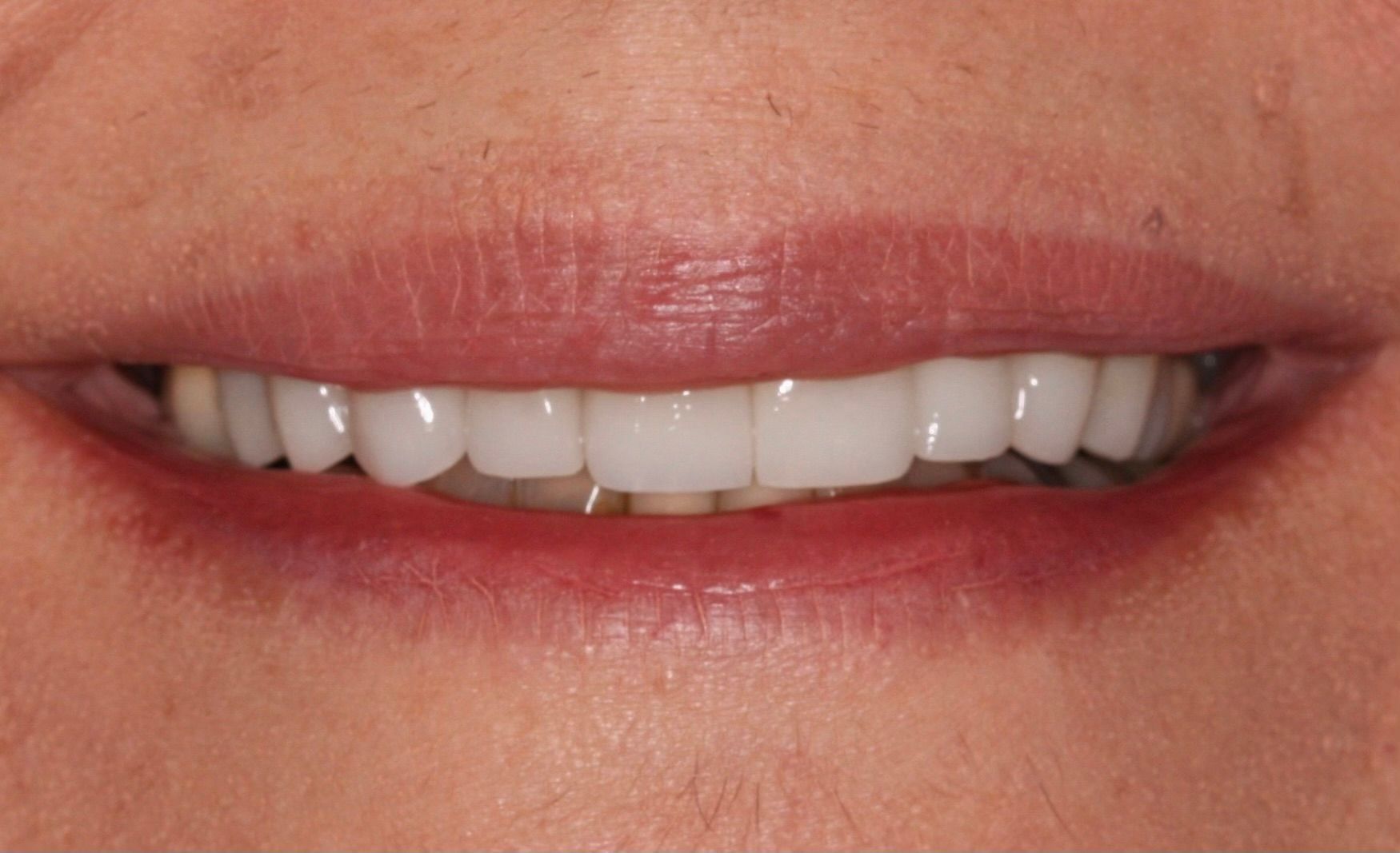 An image of teeth after a dental service