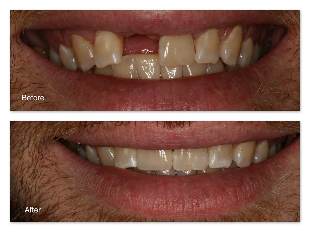A before and after picture of a man 's teeth