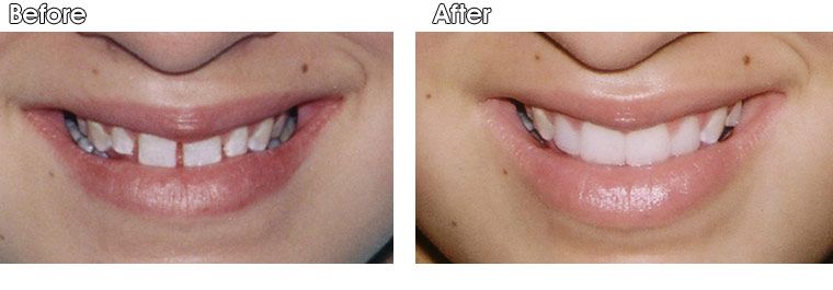A before and after picture of a woman 's smile
