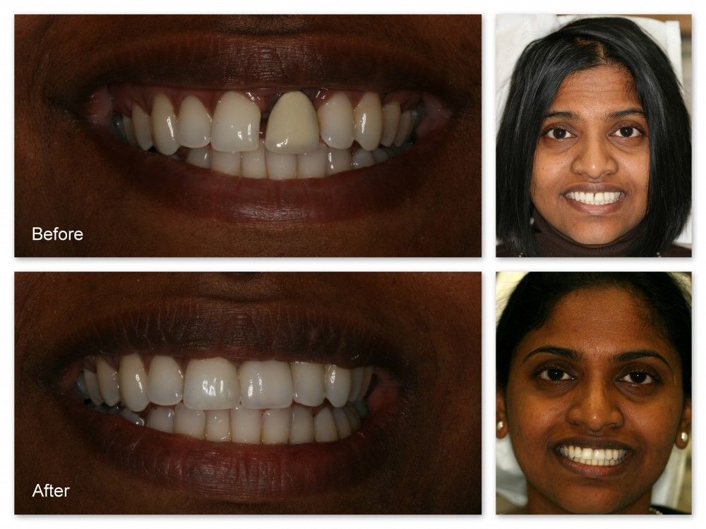 A before and after photo of a woman 's teeth