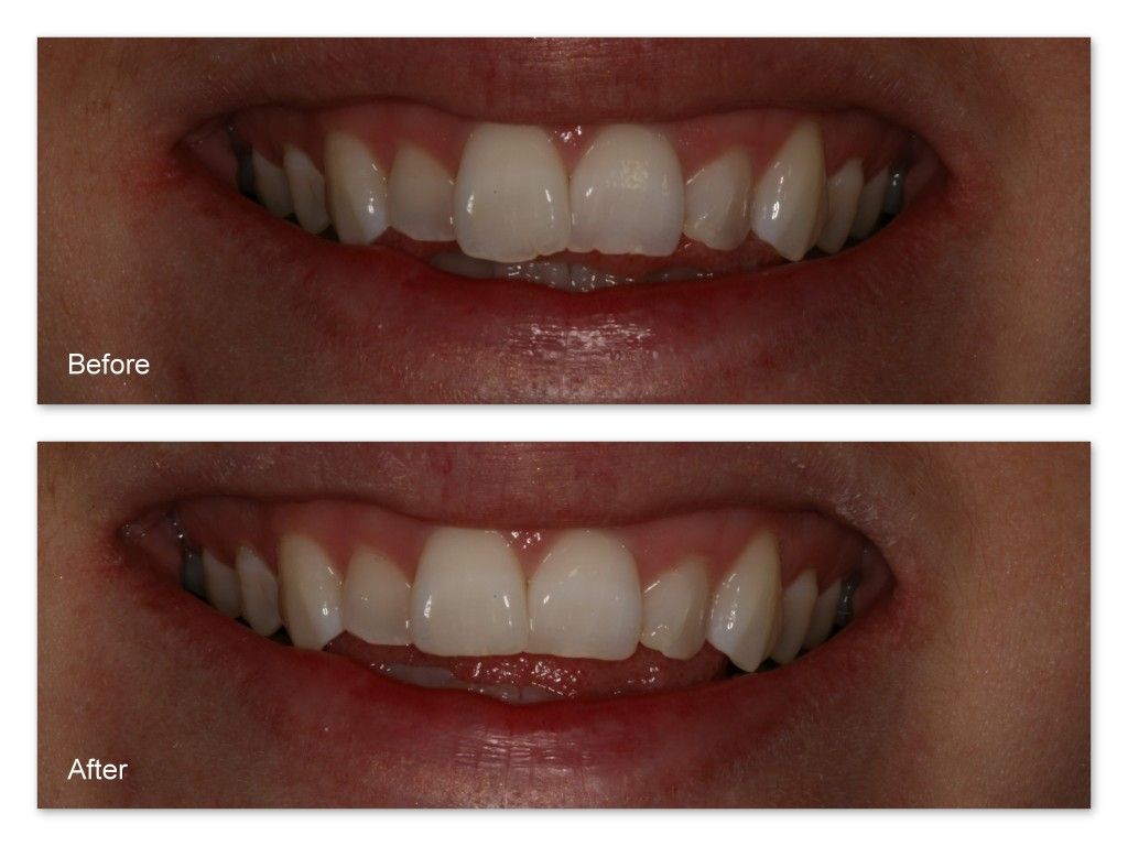A before and after picture of a person 's teeth