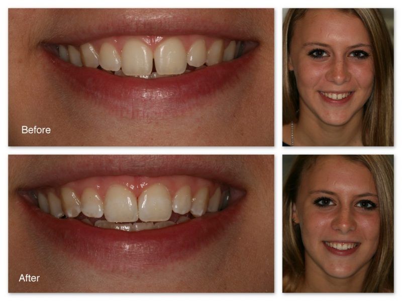 A before and after photo of a woman 's teeth