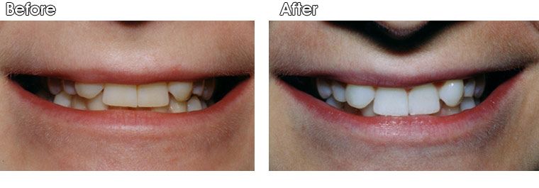 A before and after picture of a person 's teeth