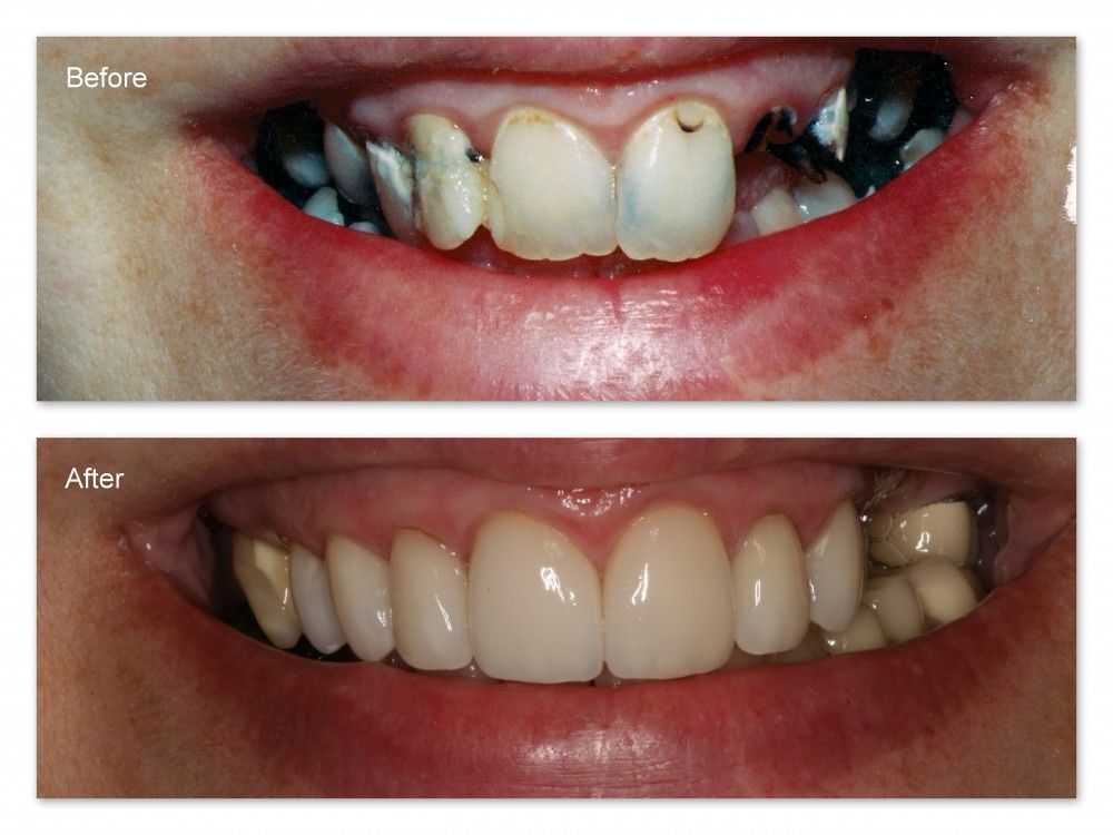A before and after picture of a person 's teeth