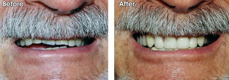 A before and after picture of a man with a beard and missing teeth.