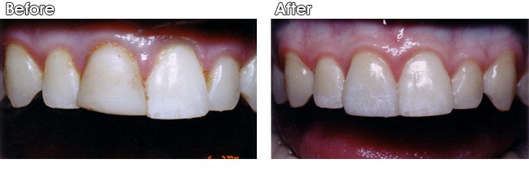 A before and after picture of a person 's teeth