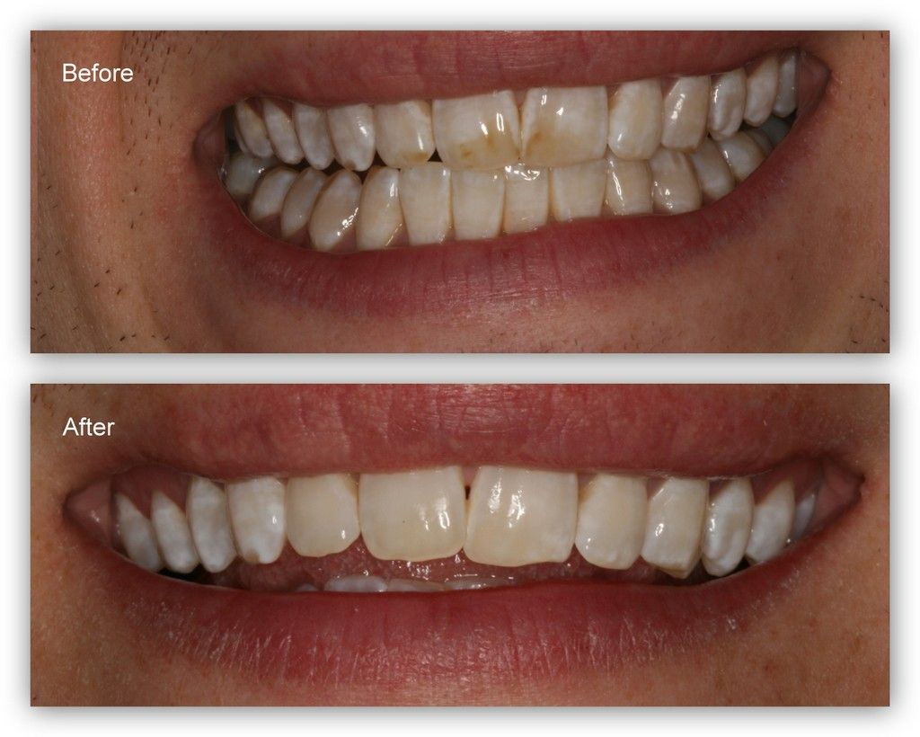 A before and after picture of a person 's teeth