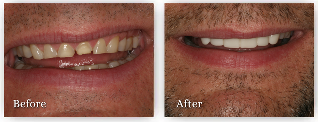 Side-by-side view of a mouth before and after dental work. Before, teeth are discolored. After, they are white and aligned.