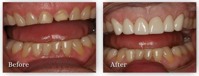 Comparison of teeth before and after dental work, showing straighter, whiter teeth.