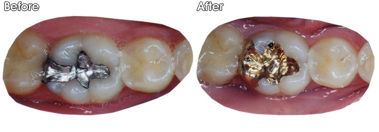 A before and after picture of a person's teeth.