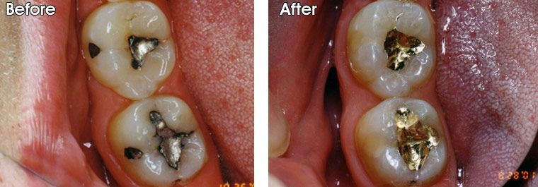 A before and after picture of a person's teeth.