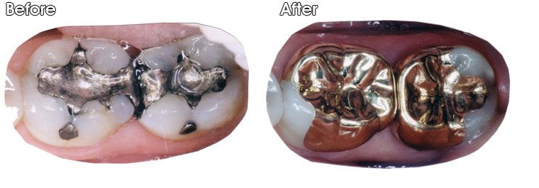 A before and after picture of a person's teeth.