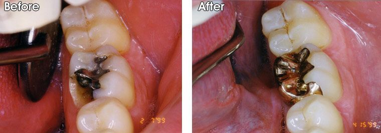 A before and after picture of a person's teeth.