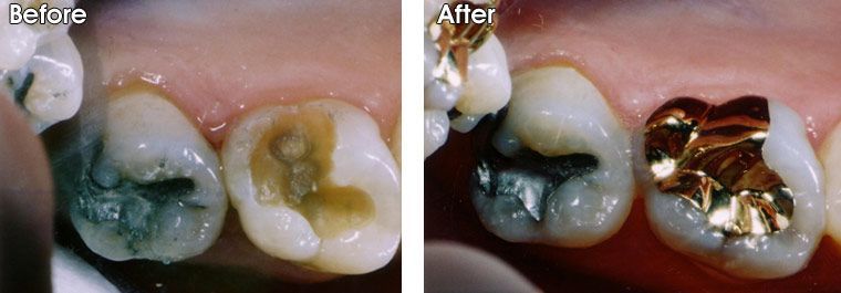A before and after picture of a person's teeth.