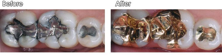 A before and after picture of a person's teeth.
