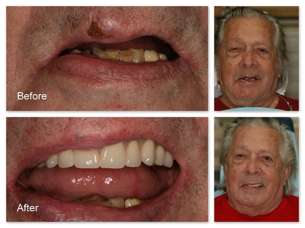 A before and after picture of a person's teeth.