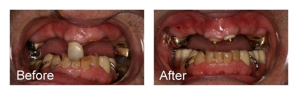 A before and after picture of a person's teeth.